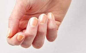 Nguyên nhân móng ngả màu vàng?
