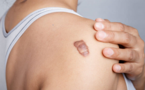 Nguyên nhân và cách giảm sẹo lồi tại nhà