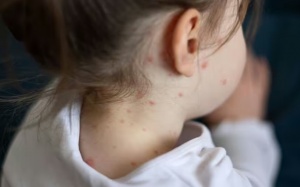 5 dấu hiệu nhận biết sớm bệnh sởi