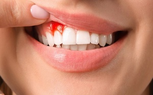 “Thủ phạm” gây chảy máu chân răng và cách cải thiện