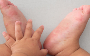 Tránh 4 sai lầm này khi điều trị tay chân miệng