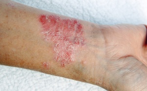 Liệu pháp mới mở ra hy vọng điều trị bệnh tự miễn ngoài da