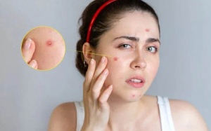 Biện pháp xử lý mụn trứng cá tại nhà