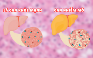 Gan nhiễm mỡ: Nguyên nhân, triệu chứng và giải pháp từ thảo dược