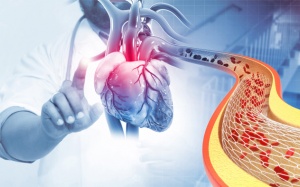 Bị bệnh mạch vành, không muốn đặt stent có cách điều trị khác không?