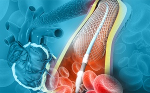 Sau khi đặt stent, cần chăm sóc như thế nào để nhanh hồi phục?