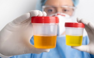 Mùi nước tiểu có thể là dấu hiệu cảnh báo bệnh suy thận