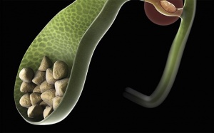 Thành mật dày 2mm và sỏi mật 3cm có nguy hiểm không?