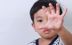 Những điều cần nhớ khi chăm sóc trẻ mắc tay chân miệng tại nhà 