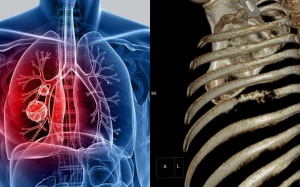 Biện pháp nâng cao sức khỏe cho người bệnh ung thư phổi di căn xương 