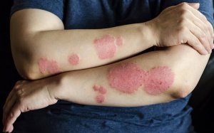 4 mẹo giúp làm sạch vảy nến trên da 