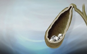 Sỏi túi mật 12mm là to hay nhỏ, có nguy hiểm không?