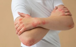 Giảm cân giúp cải thiện bệnh vẩy nến? 