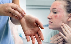 Lupus ban đỏ dạng đĩa ảnh hưởng đến sức khỏe ra sao?