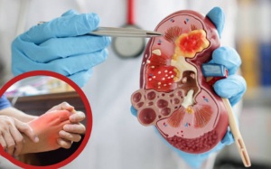 Suy thận - Biến chứng nguy hiểm từ bệnh gout