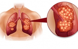 Ung thư phổi giai đoạn 2 và những thông tin hữu ích 