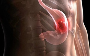 5 dấu hiệu cảnh báo ung thư dạ dày bạn cần biết