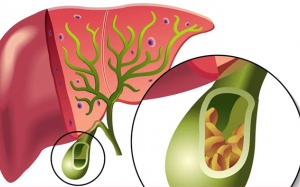 Ngoài 60 tuổi, bị sỏi túi mật 17mm nên uống thuốc hay phẫu thuật?