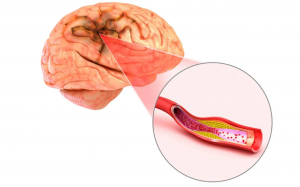 Phình động mạch não nguy hiểm thế nào và cách phòng ngừa?
