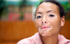 Bạch biến có chữa khỏi hẳn được không?