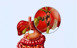 Sau khi cắt túi mật, có nên dùng thảo dược lợi mật không?