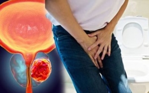 Dấu hiệu ung thư tuyến tiền liệt bạn không nên bỏ qua