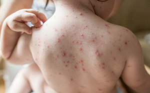 Điều trị thuỷ đậu cần tránh mắc 5 sai lầm này