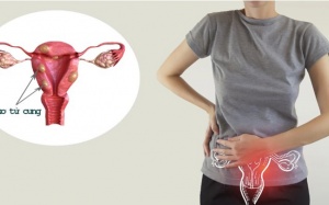 U xơ tử cung có nguy hiểm không? 