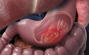 Ung thư đại trực tràng phát hiện sớm có thể chữa khỏi hoàn toàn