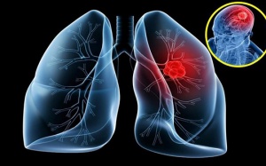 Vẫn sống khỏe sau 7 năm mắc ung thư phổi di căn não