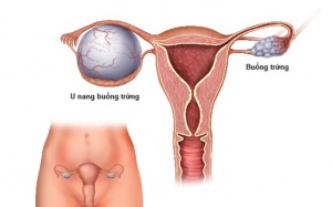 Tìm hiểu về các dạng u nang buồng trứng thường gặp