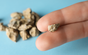 5 dấu hiệu cần chú ý để phát hiện sỏi thận kịp thời