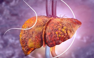 FDA phê duyệt loại thuốc đầu tiên điều trị bệnh gan nhiễm mỡ