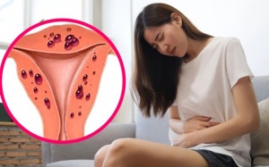 Làm thế nào để đối phó với cơn đau do lạc nội mạc tử cung?