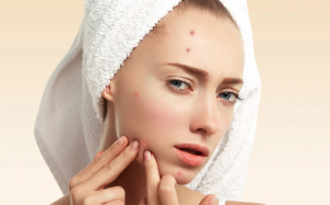 Da mụn có nên dùng acid hyaluronic?