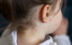 Thủy đậu dễ lây lan, nên chăm sóc trẻ bị thủy đậu ra sao?