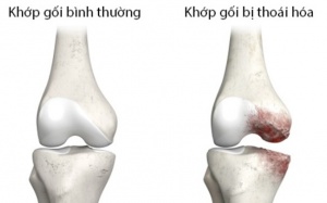 Thoái hóa khớp: Mức độ nguy hiểm và cách điều trị