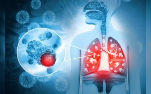 Đâu là nguyên nhân gây ung thư phổi phổ biến?