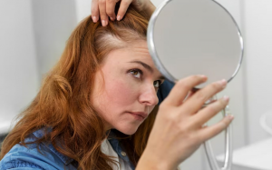 Giảm mụn da đầu với nguyên liệu tự nhiên