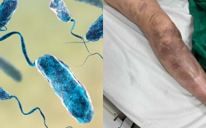 Nhiễm khuẩn huyết từ vết đâm do ngạnh cá trê  