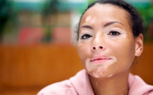 Bệnh bạch biến và giải pháp từ thảo dược