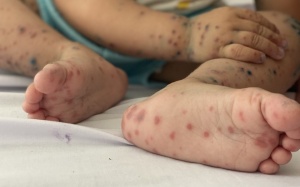 Số ca mắc bệnh tay chân miệng tăng cao ở Hà Nội