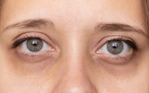 Có những cách nào giúp loại bỏ quầng thâm dưới mắt?