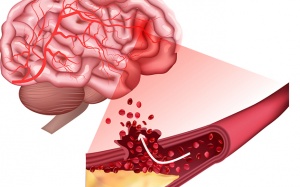 Xuất huyết não nguy hiểm ra sao?