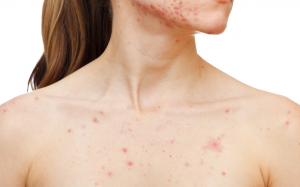 Mụn ở ngực do đâu và cách khắc phục?