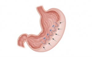 Phẫu thuật thu nhỏ dạ dày ESG có giúp giảm cân?