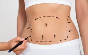 Cảnh báo biến chứng nặng do hút mỡ bụng thẩm mỹ