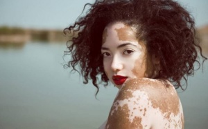 Liệu bạch biến có thể tự khỏi được không?