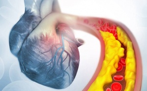 Thiếu máu cơ tim kèm bệnh mạch vành, cần làm gì để giảm nguy cơ đặt stent?