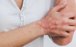 Bệnh vảy nến giai đoạn đầu có biểu hiện ra sao?